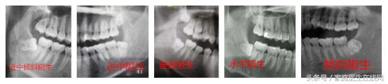 拔一颗智齿会掉智商还能瘦脸？别闹了！口腔科医生来辟谣