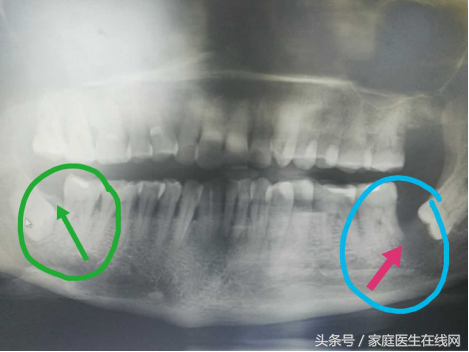 拔一颗智齿会掉智商还能瘦脸？别闹了！口腔科医生来辟谣