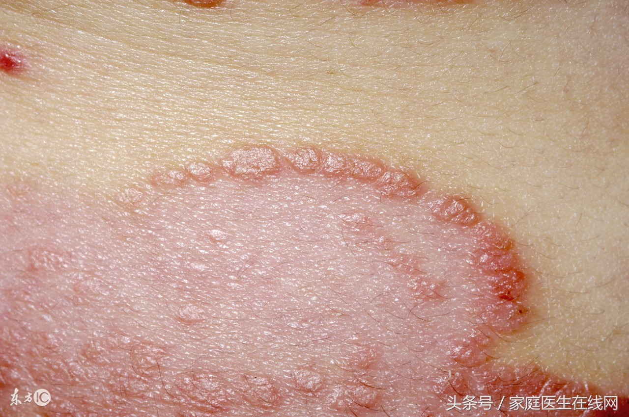 蜈蚣咬了怎么办假期慎防3类皮肤疾病