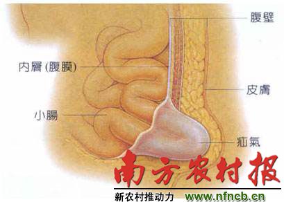 七旬翁腹部术口鼓出大包块 四个大疝气一次手术除