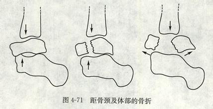 距骨骨折怎么办