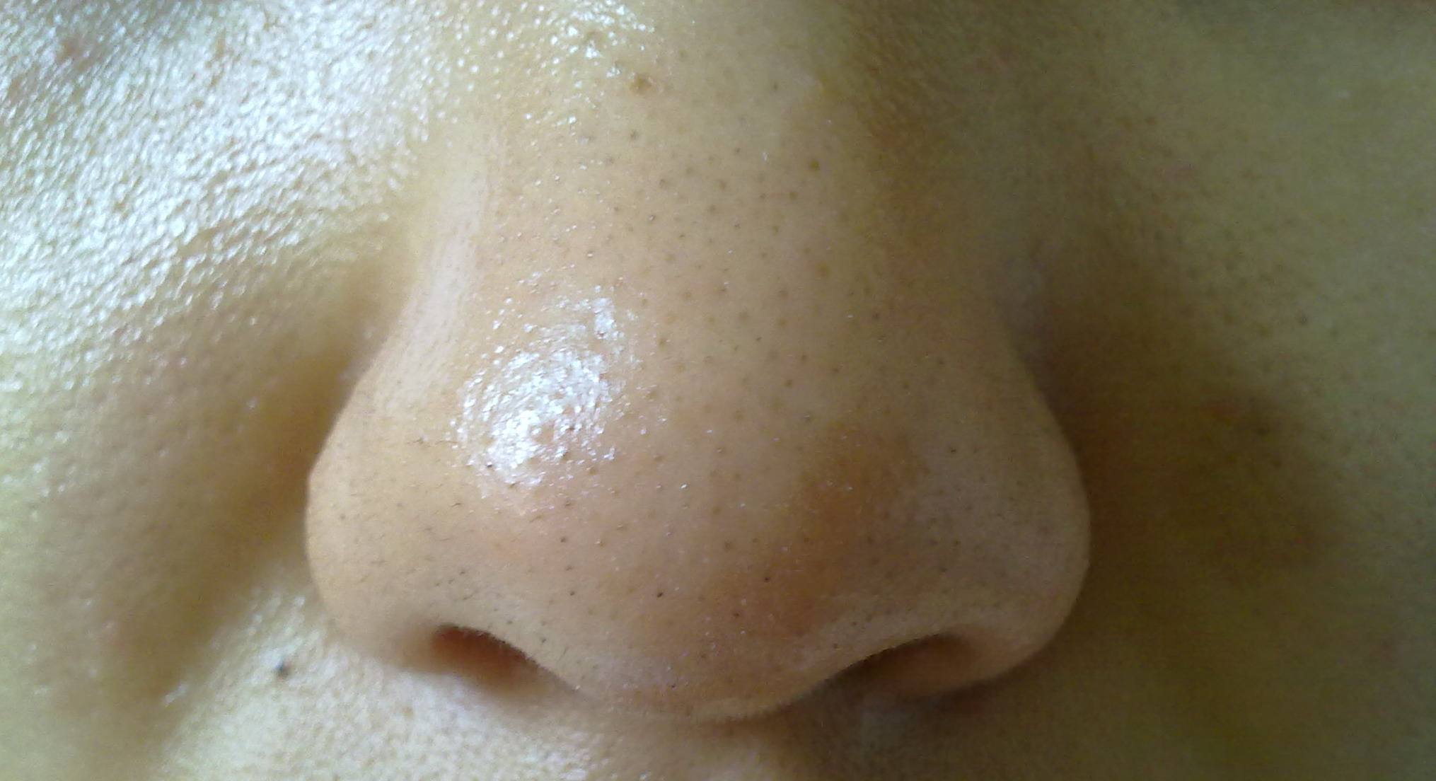 酒糟鼻怎样能治好 酒糟鼻用什么药好得快-星星快文