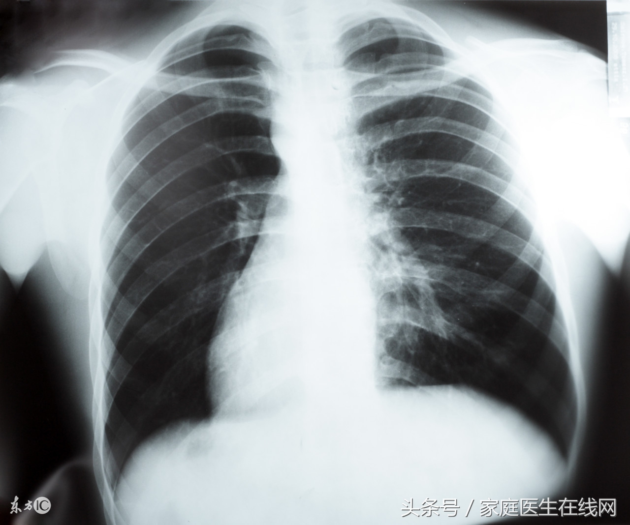 介入专家详解：做肺穿刺活检，患者该知道这些事