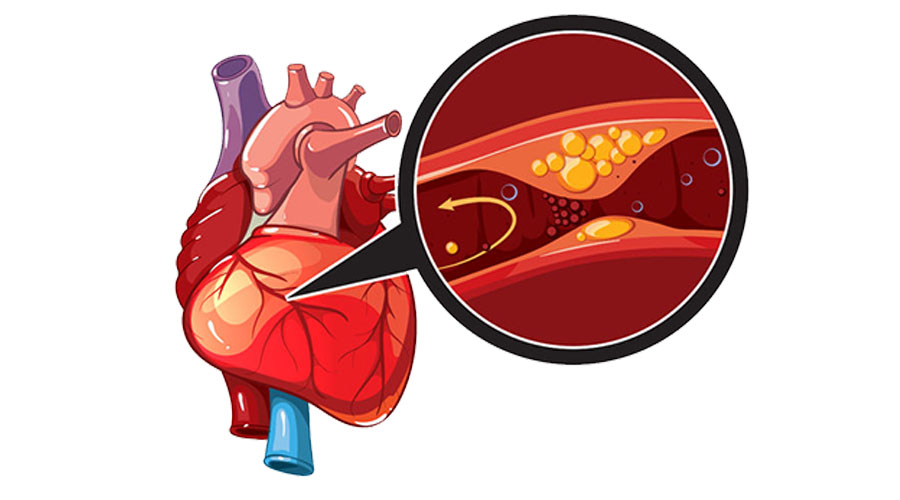 突发心绞痛怎么处理(10字急救要诀)