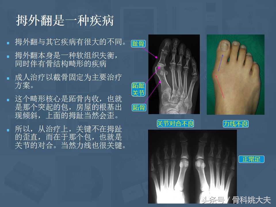 穿不了高跟鞋的拇外翻真让人烦躁，到底保守和手术治疗怎么搞啊