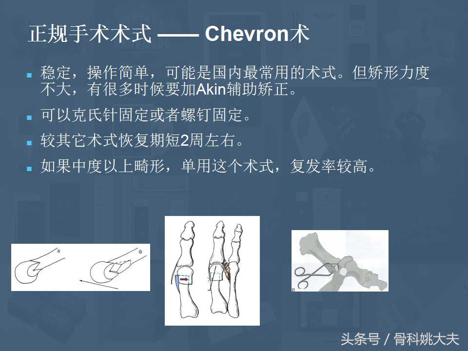 穿不了高跟鞋的拇外翻真让人烦躁，到底保守和手术治疗怎么搞啊