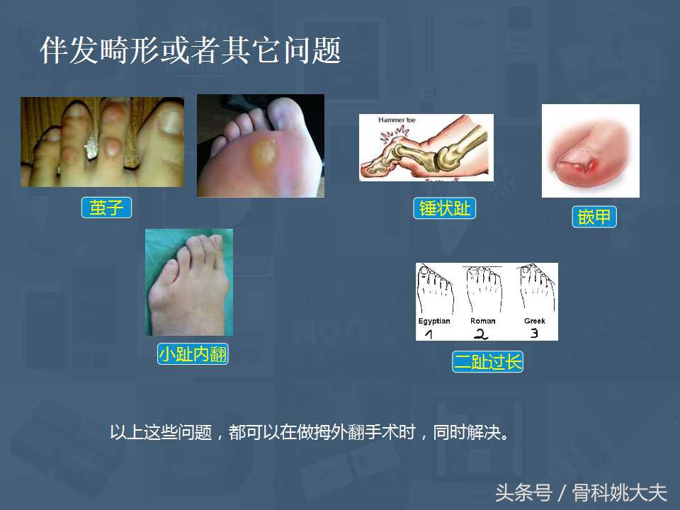 穿不了高跟鞋的拇外翻真让人烦躁，到底保守和手术治疗怎么搞啊