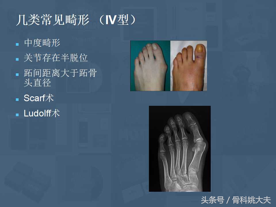 穿不了高跟鞋的拇外翻真让人烦躁，到底保守和手术治疗怎么搞啊