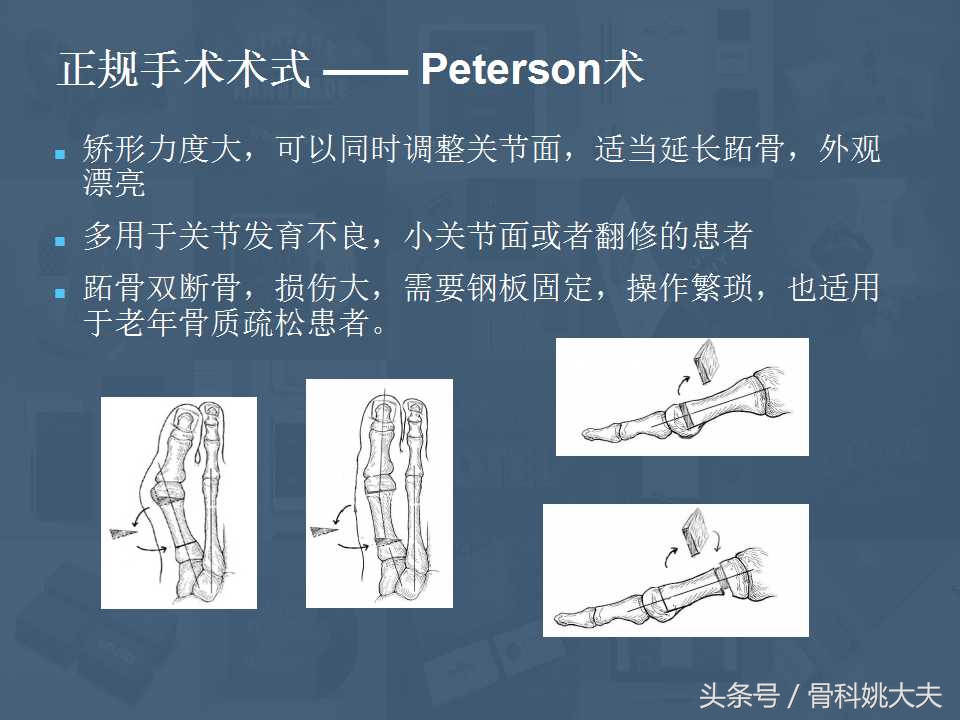 穿不了高跟鞋的拇外翻真让人烦躁，到底保守和手术治疗怎么搞啊