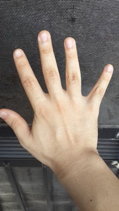 详细分析:手腕背面有痣代表什么?有利有弊!