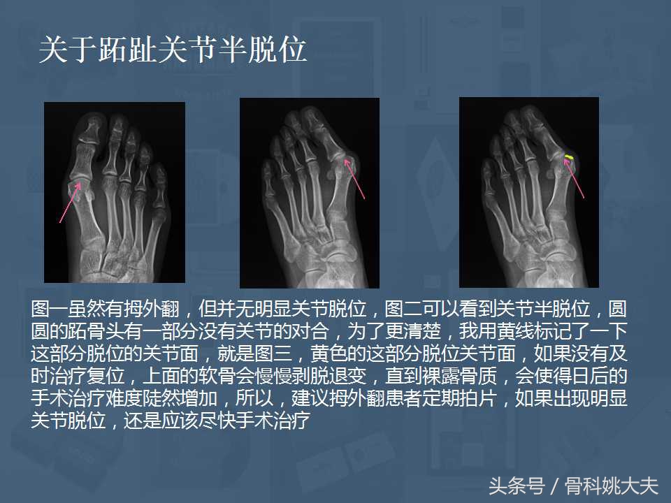 穿不了高跟鞋的拇外翻真让人烦躁，到底保守和手术治疗怎么搞啊