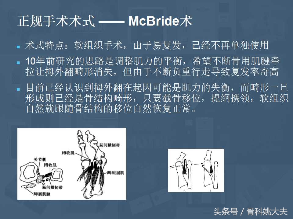 穿不了高跟鞋的拇外翻真让人烦躁，到底保守和手术治疗怎么搞啊