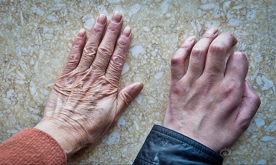 大腿肌肉萎缩:股骨头坏死病人出现大腿肌肉萎缩是普通现象,肌肉萎缩的