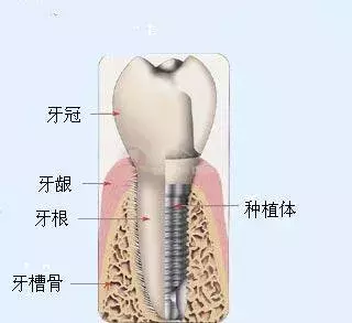 收藏 | 史上最全最易懂的种植牙知识都在这里！