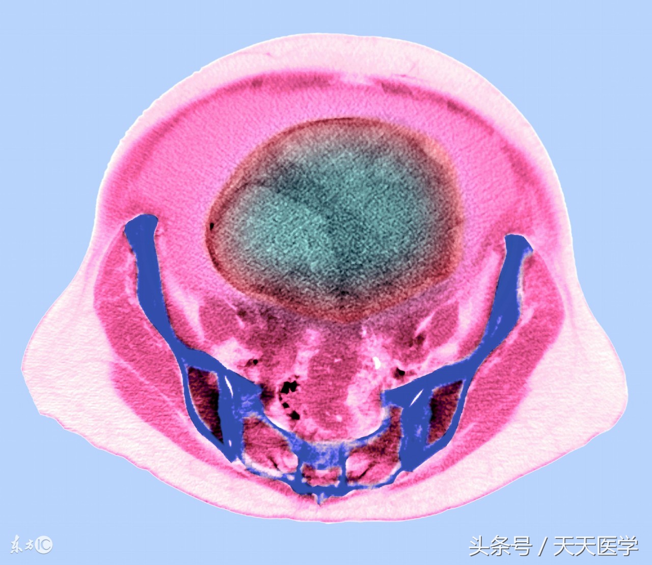 腹水症状四大体征（腹水症状四大体征表现）-第2张图片-华展网