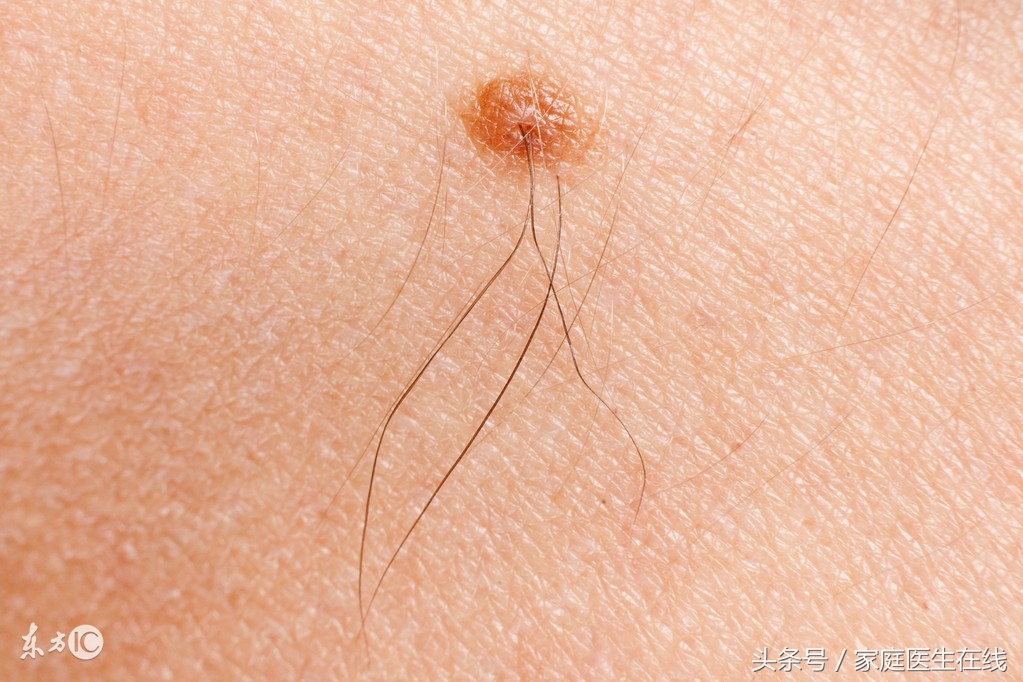 王小姐今年三十岁了,作为一个女生,她经常觉得自己脸上那颗会长毛的痣