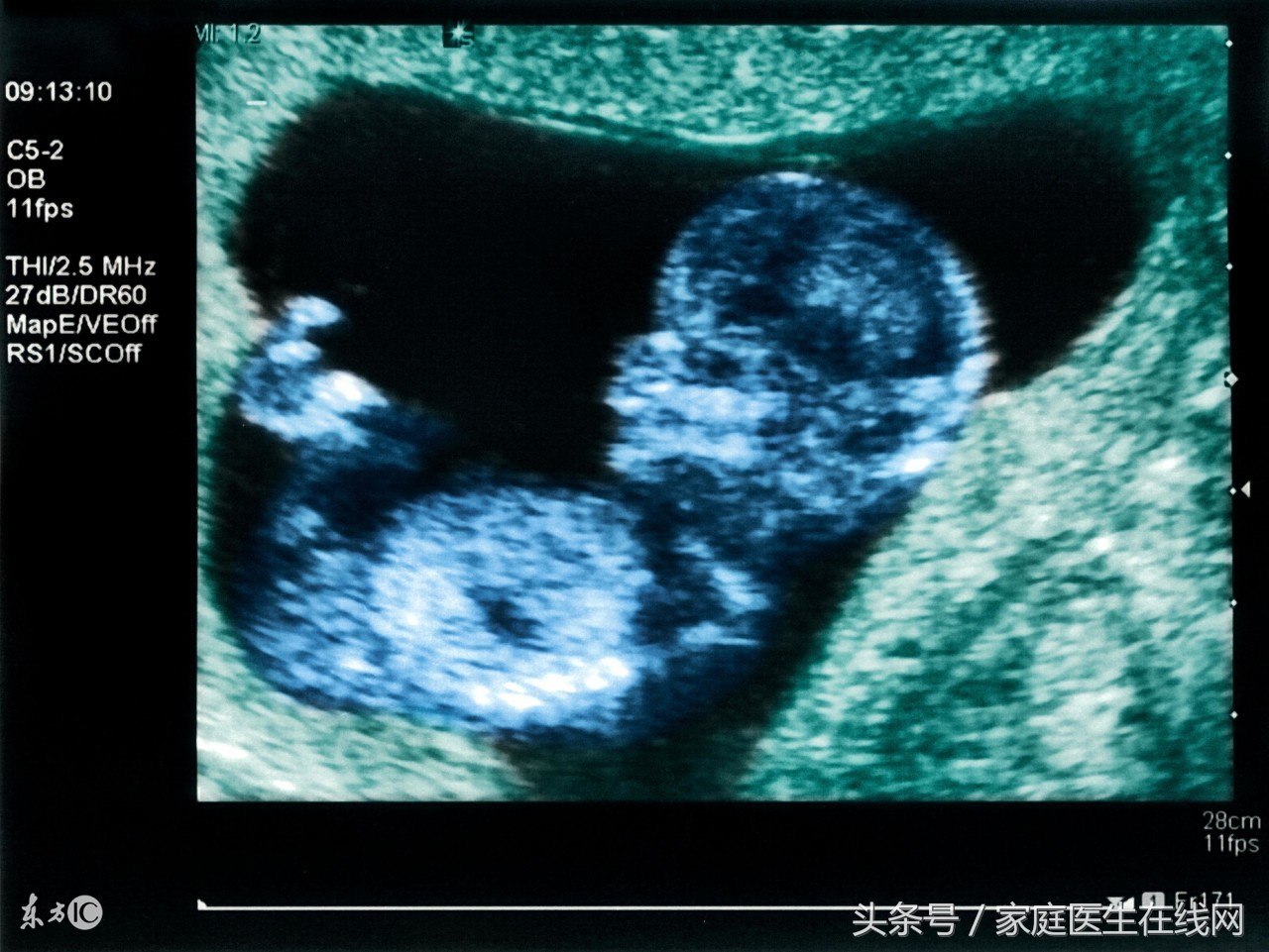 子宫直肠窝积液是怎么回事？盆腔积液正常吗？