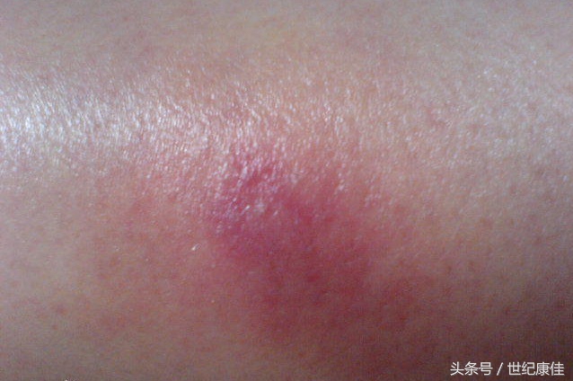 火疖子是怎么引起的？七草缘解析病因
