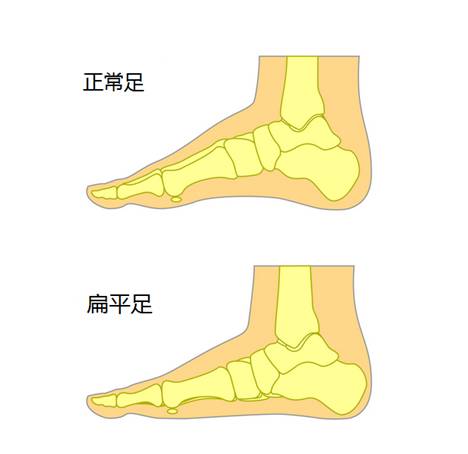 怎樣判斷寶寶是否有扁平足?該如何預防?