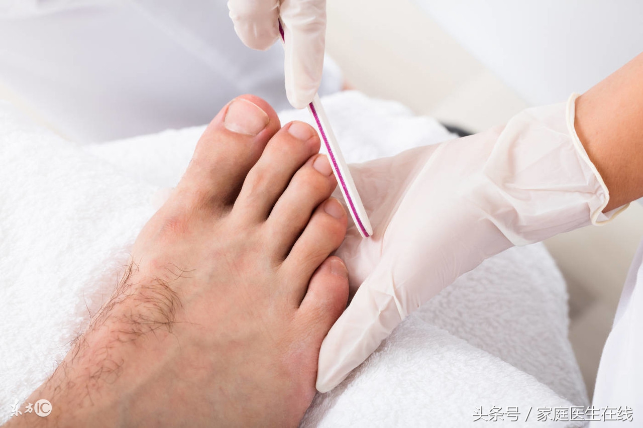 鸡眼治疗方法大全：除修脚外的自然疗法与家庭护理方案