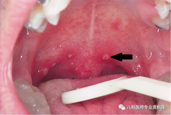 成人感染手足口病的症状_成人感染手足口病初期症状图片_成人感染手足口病毒会传染吗