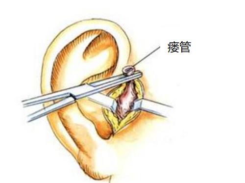 耳前瘘管到底是什么？有什么症状？该如何治疗？