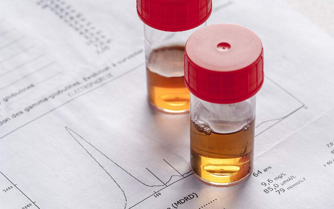 肾病患者请注意:尿潜血2 是传说中的"佛系治疗"