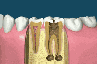 牙冠材料选择(做牙冠到底哪种材料比较好？)