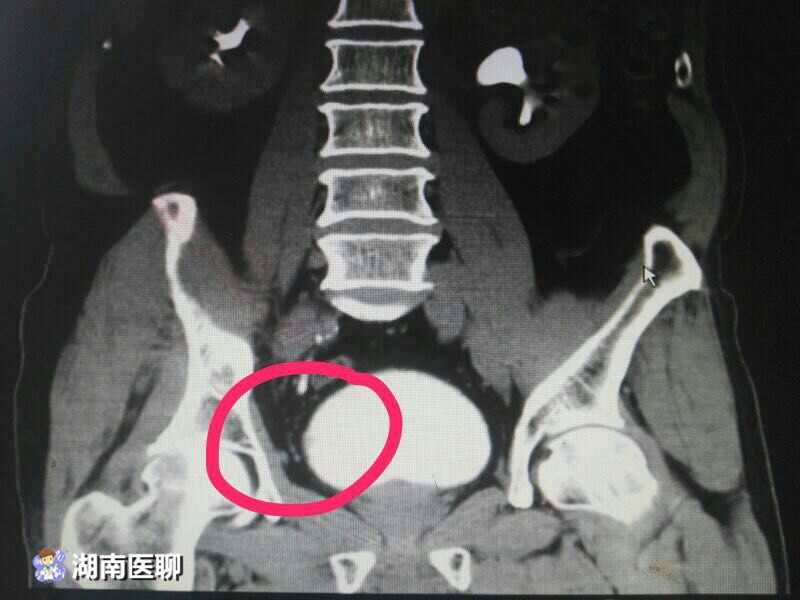 膀胱癌的主要诱发因素及危险因素分析