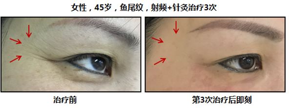 颈纹、眉纹、鱼尾纹：《我们不一样》！