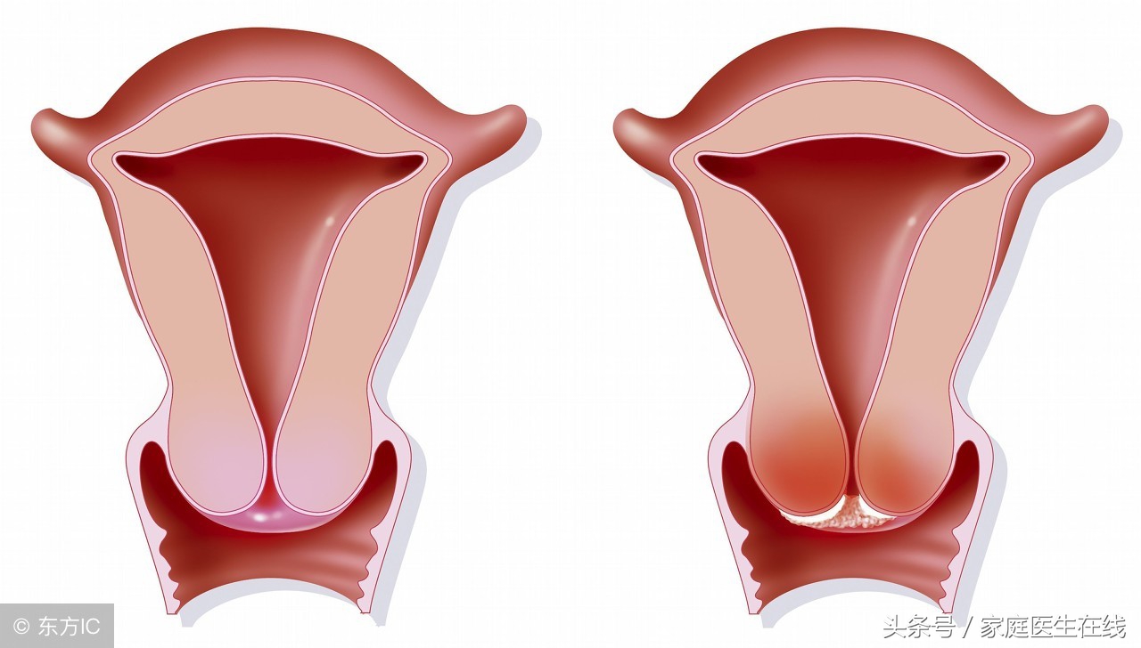 妇科医生向女士们发声：把握这个原则，宫颈癌也能治疗好！