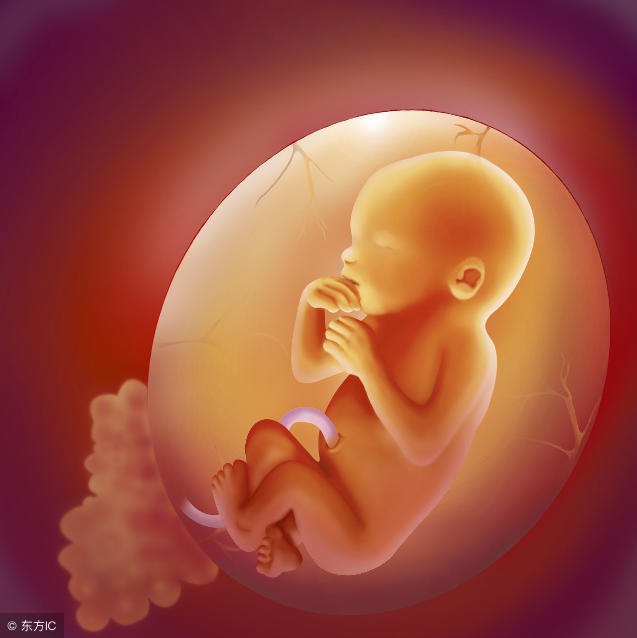 梅毒胎儿图片