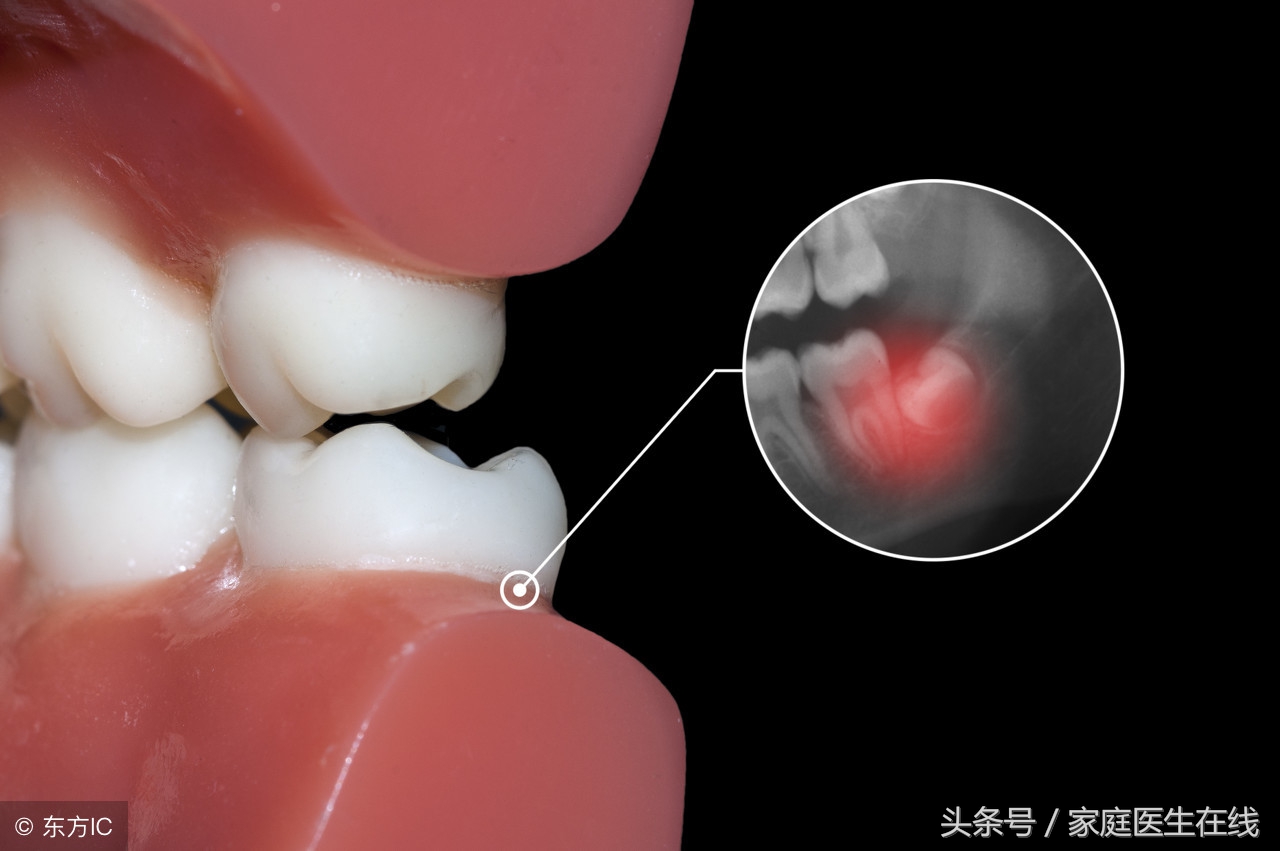智齿到底应不应该拔掉(智齿到底该不该拔？看完这5点，答案呼之欲出)
