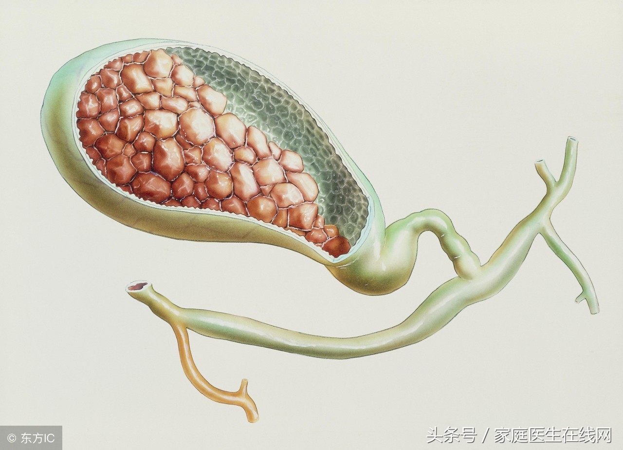 胆结石是药物治疗好，还是手术切除好？医生一一分析给你听