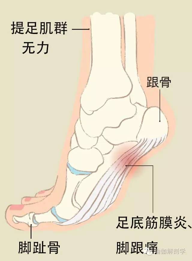 足底筋膜炎位置图（6种人容易发生足底筋膜炎）