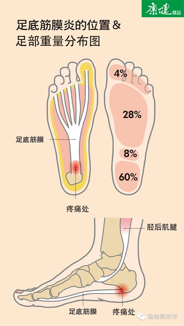 足底筋膜炎位置图（6种人容易发生足底筋膜炎）