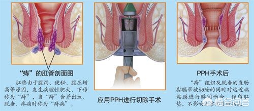 得了痔疮怎么办，是不是所有的痔疮都需要手术，听听医生怎么说