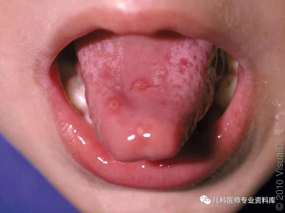 手足口病症状初期图片 手足口疱疹图片-春风号,忽如一夜春风来千树