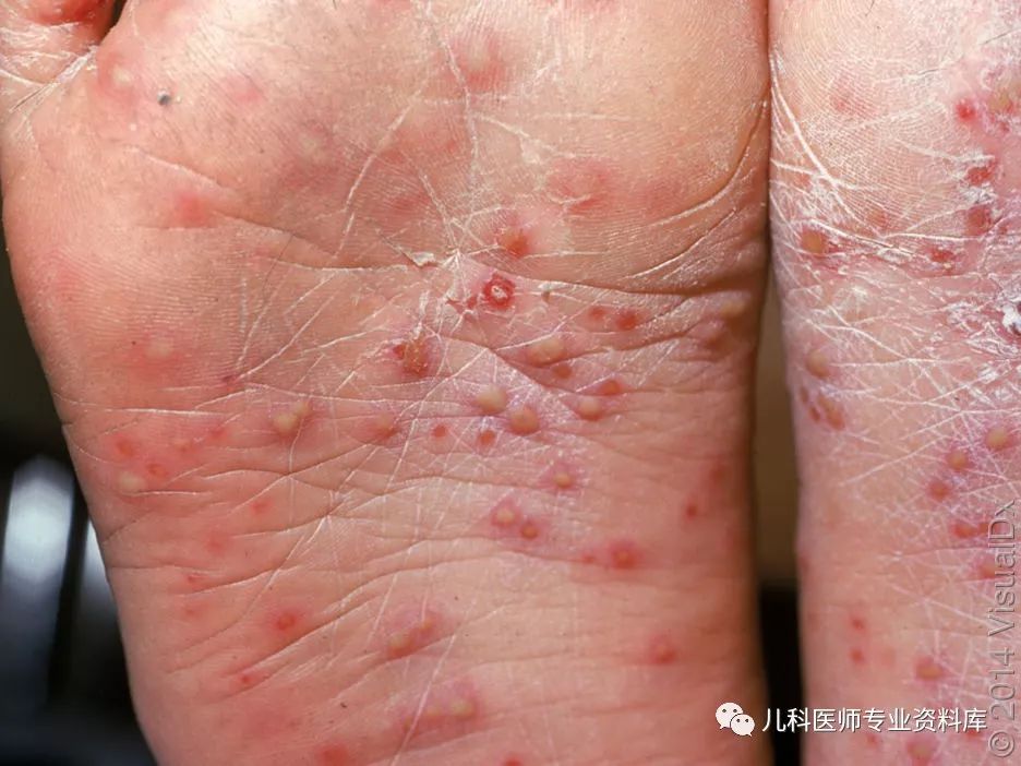 手足口病症状初期图片 手足口疱疹图片-春风号,忽如一夜春风来千树