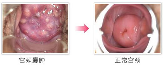 子宫纳囊如何治疗(宫颈囊肿是癌症吗？)