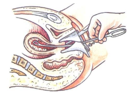 取环手术全过程（附图）