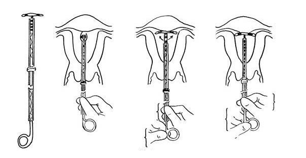 取环手术全过程（附图）