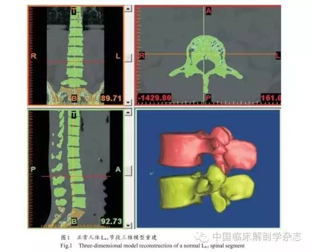 临床生物力学下腰椎融合术后路单、双侧椎弓根固定的有限元比较研究