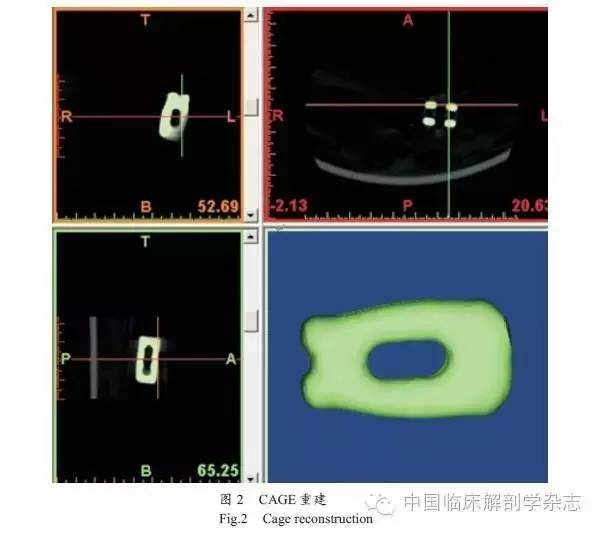 临床生物力学下腰椎融合术后路单、双侧椎弓根固定的有限元比较研究