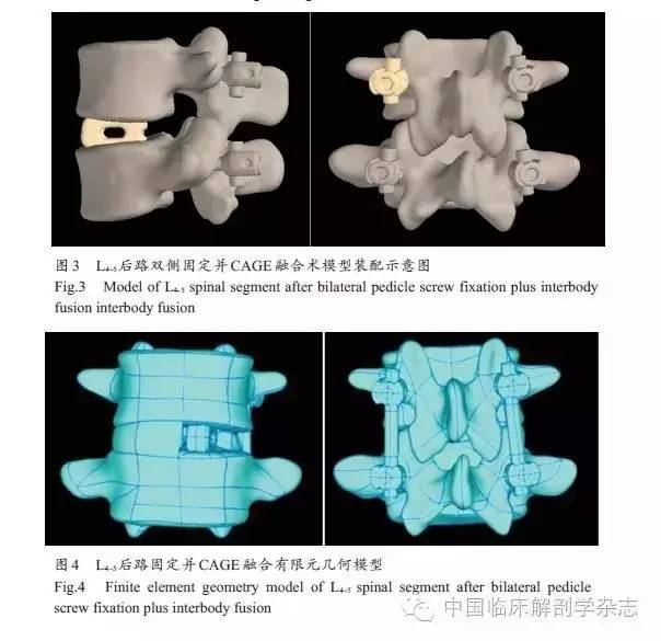 临床生物力学下腰椎融合术后路单、双侧椎弓根固定的有限元比较研究