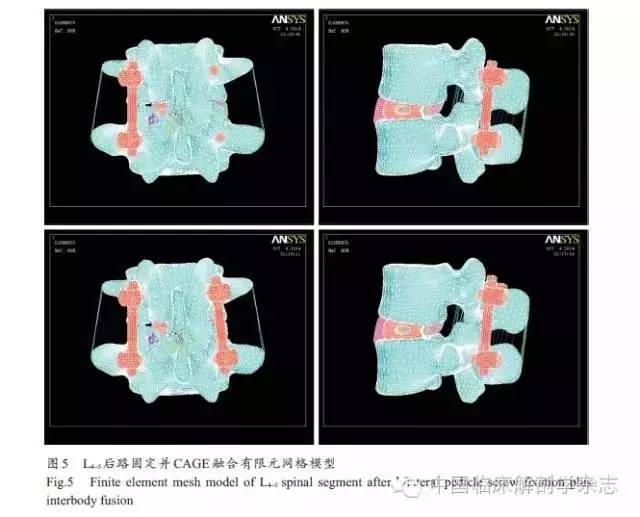 临床生物力学下腰椎融合术后路单、双侧椎弓根固定的有限元比较研究