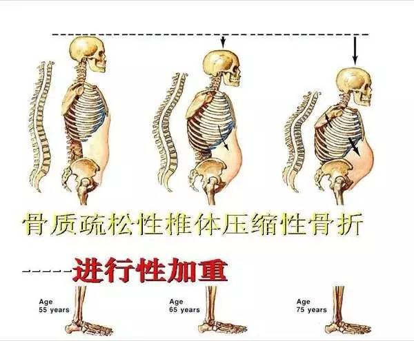 83岁奶奶压缩性骨折，注入“骨水泥”三天就康复出院了