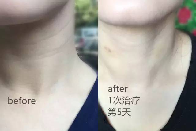 常识趴 | 顽固皱纹怎么去除？为什么有的方法没效果？(下）