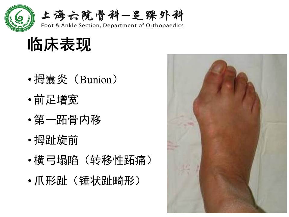 得了拇外翻怎么办？ - 标件库