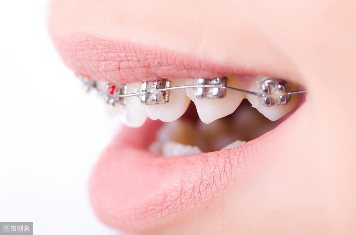 做牙齿矫正，你得先知道正畸可能出现的副作用，牙科医生的真建议